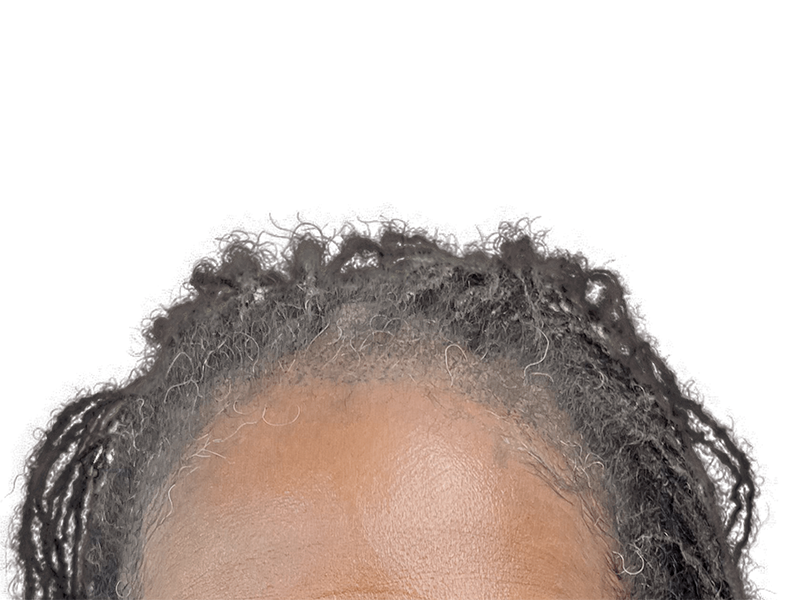 Graying hairline close-up. Considering hair restoration? Explore hair transplant options for receding hairlines. Before/After results may vary.