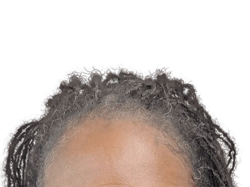 Graying hairline close-up. Considering hair restoration? Explore hair transplant options for receding hairlines. Before/After results may vary.
