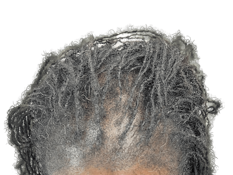 Thinning dreadlocks, scalp visible. Potential hair loss case. Could be a hair transplant candidate. Consult for options.