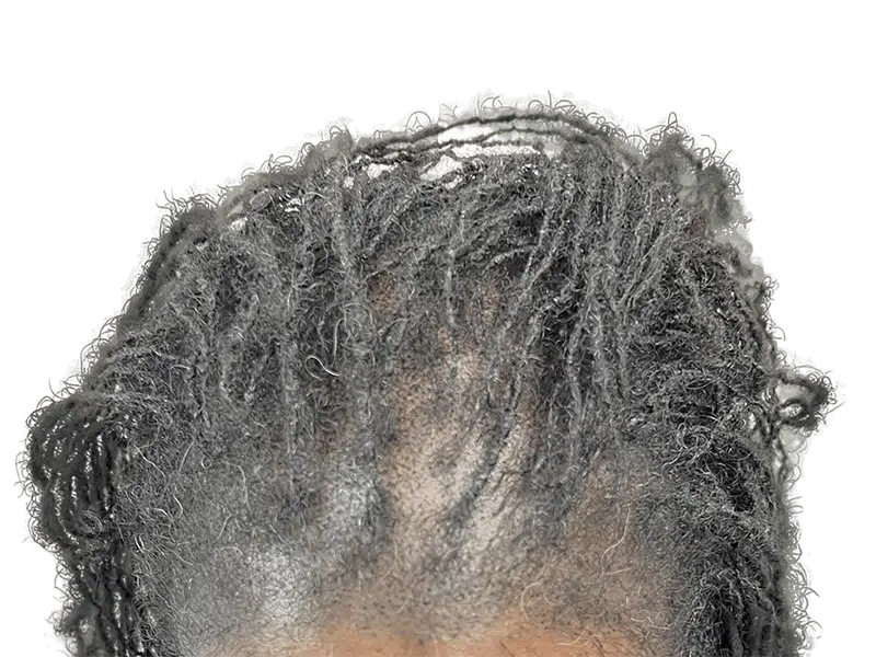 Thinning dreadlocks, scalp visible. Potential hair loss case. Could be a hair transplant candidate. Consult for options.