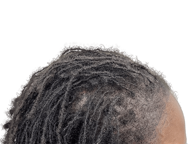 Hair thinning in Black hair, styled in dreadlocks. Potential hair transplant before/after. Hair restoration services.