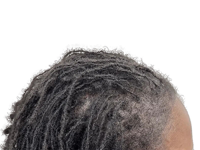 Hair thinning in Black hair, styled in dreadlocks. Potential hair transplant before/after. Hair restoration services.