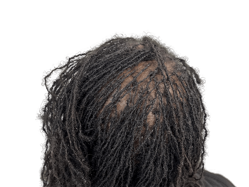 Dreadlocks; potential hair density after restoration. Scalp visibility limited. Hair transplant before/after unclear.