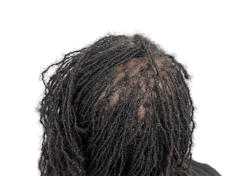 Dreadlocks; potential hair density after restoration. Scalp visibility limited. Hair transplant before/after unclear.