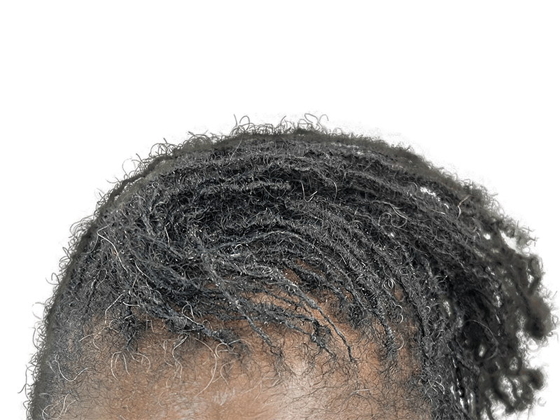 Graying dreadlocks. Potential hair restoration candidate. No visible hair transplant. Before treatment example.