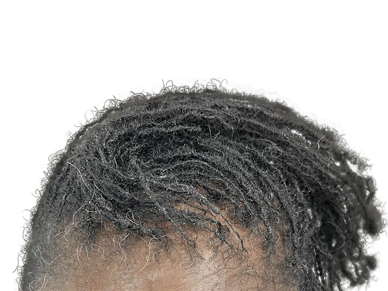 Graying dreadlocks. Potential hair restoration candidate. No visible hair transplant. Before treatment example.