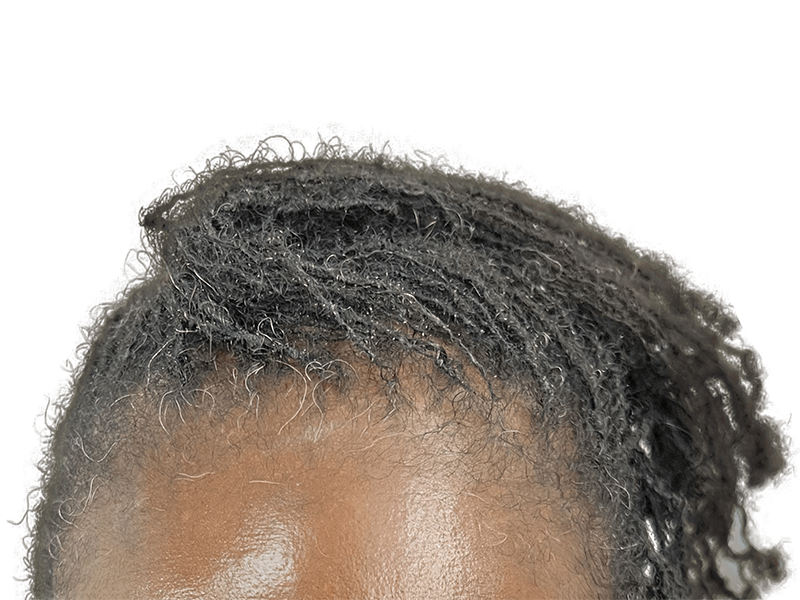 Graying locs/twists on dark skin. Hair restoration example? No transplant or before/after visible.