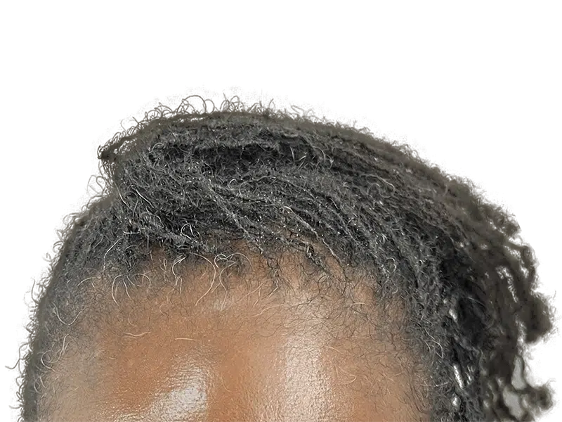 Graying locs/twists on dark skin. Hair restoration example? No transplant or before/after visible.