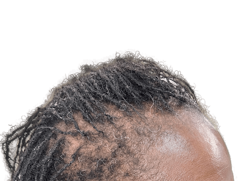 Dreadlocks with graying hair. Considering hair restoration? Explore options for fuller, youthful-looking hair. No transplant shown.
