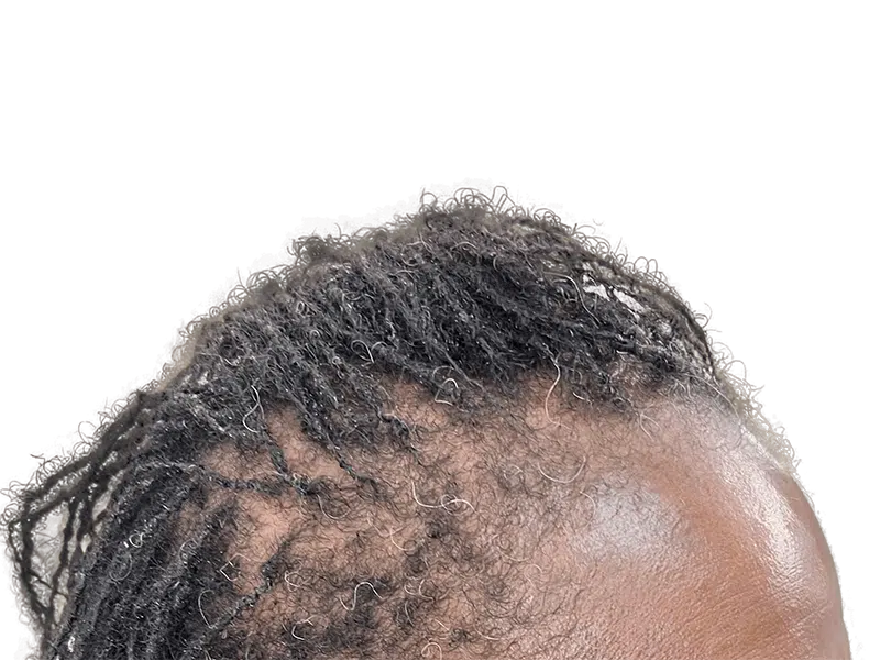 Dreadlocks with graying hair. Considering hair restoration? Explore options for fuller, youthful-looking hair. No transplant shown.