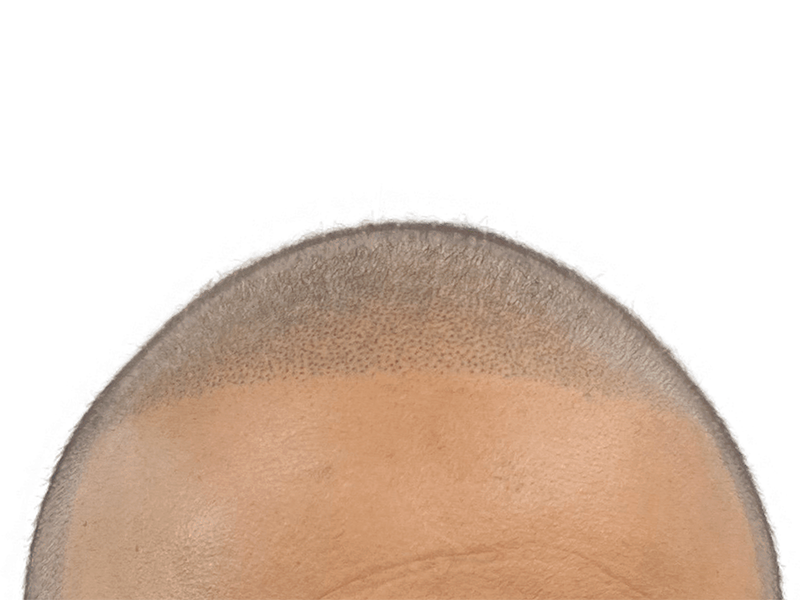 Hair transplant result: Close-up of new hairline with evenly distributed hair growth. Hair restoration procedure success.