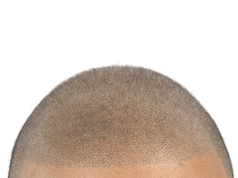 Close-up of scalp showing thinning hair. Could be before or after hair restoration/transplant. Light brown/blonde hair.