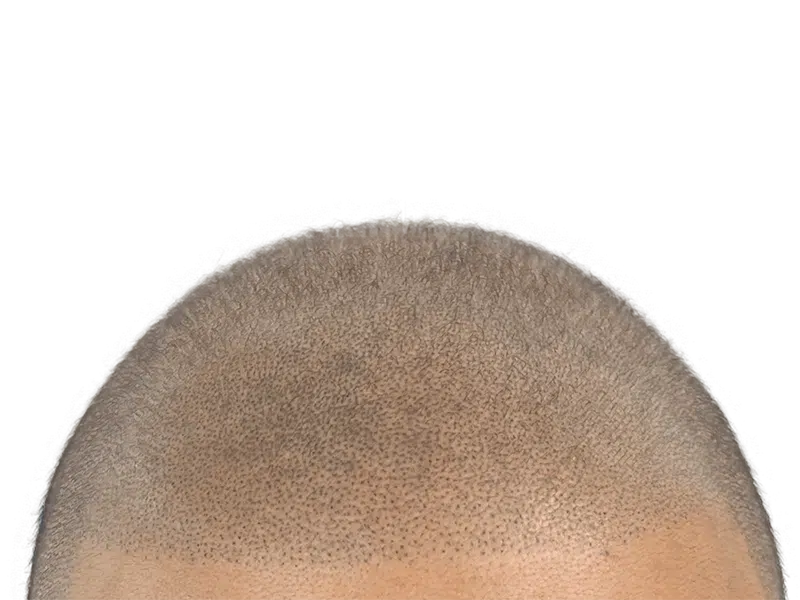 Close-up of scalp showing thinning hair. Could be before or after hair restoration/transplant. Light brown/blonde hair.