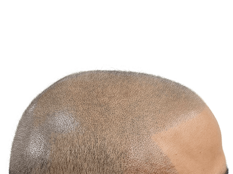 Hair transplant result: Close-up of restored hairline. Dense, fine hair growth after hair restoration procedure.