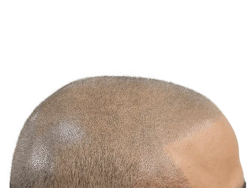 Hair transplant result: Close-up of restored hairline. Dense, fine hair growth after hair restoration procedure.
