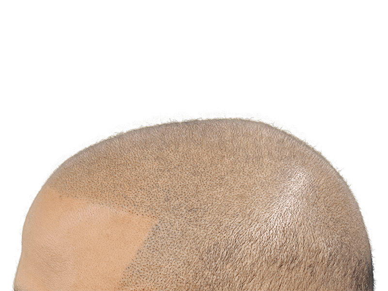 Hair transplant result: Bald scalp with new hair growth at hairline. Hair restoration procedure success.