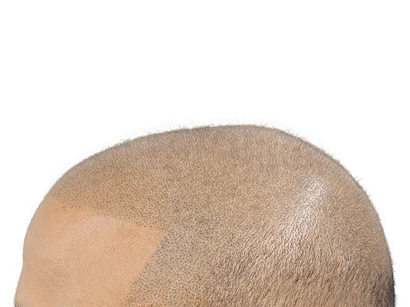 Hair transplant result: Bald scalp with new hair growth at hairline. Hair restoration procedure success.