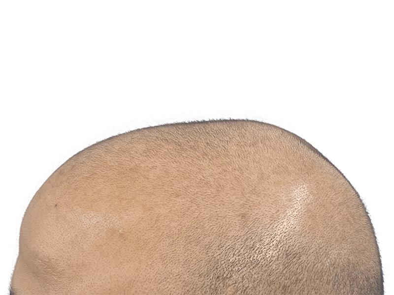 Male with thinning hair. Hair restoration candidate? Before hair transplant. Light brown skin, closely cropped hair.