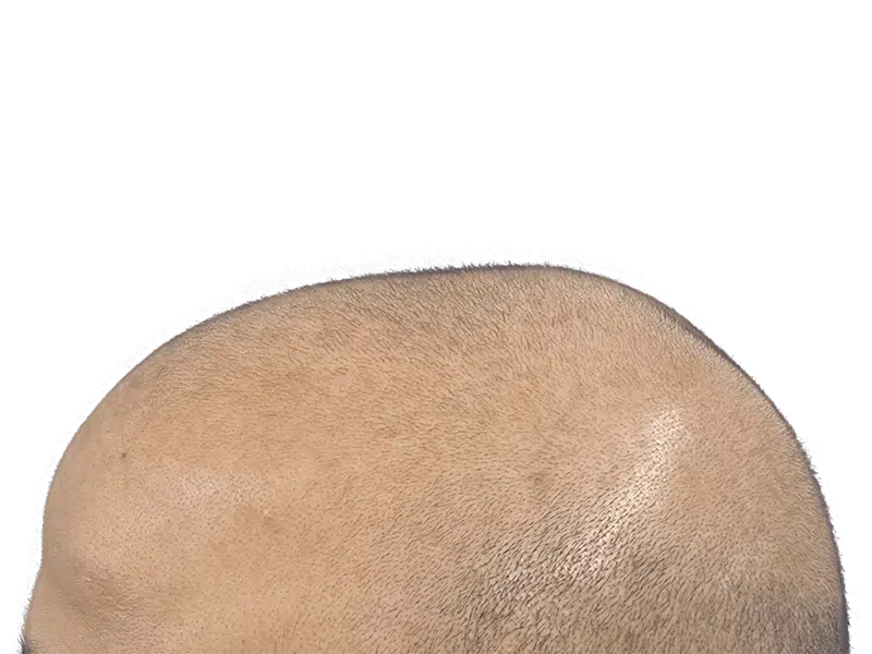 Male with thinning hair. Hair restoration candidate? Before hair transplant. Light brown skin, closely cropped hair.