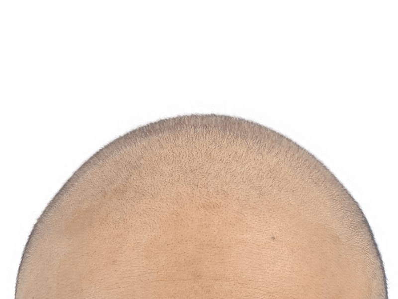 Hair transplant result: Light brown hair evenly distributed across scalp. Successful hair restoration procedure.