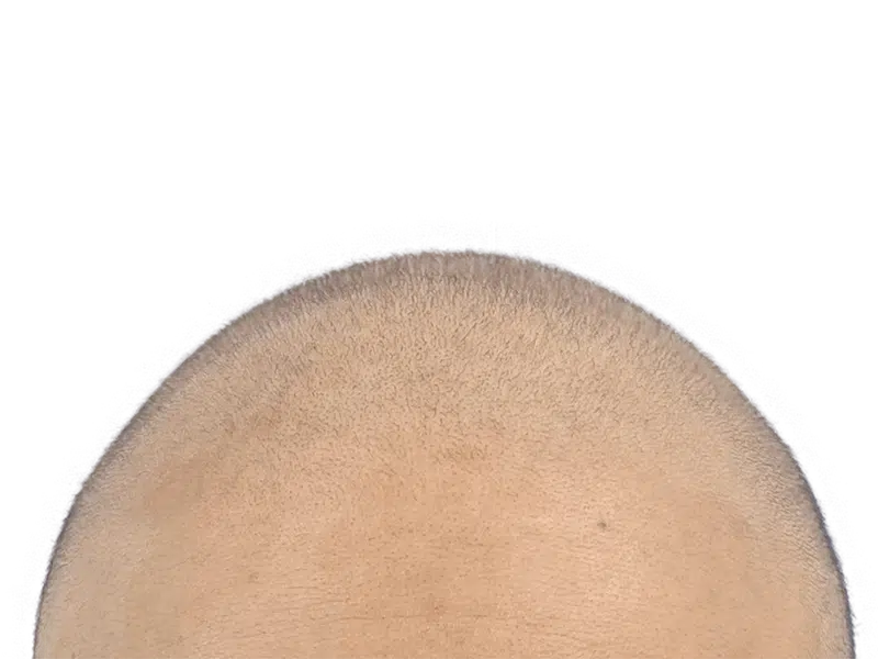 Hair transplant result: Light brown hair evenly distributed across scalp. Successful hair restoration procedure.