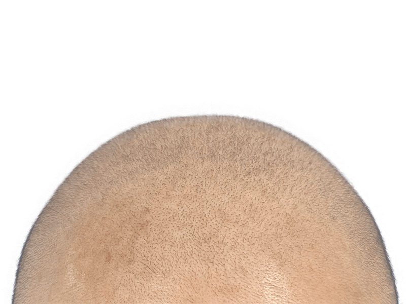 Hair transplant close-up: New hair growth evenly distributed. Restoration results showcase density and coverage.