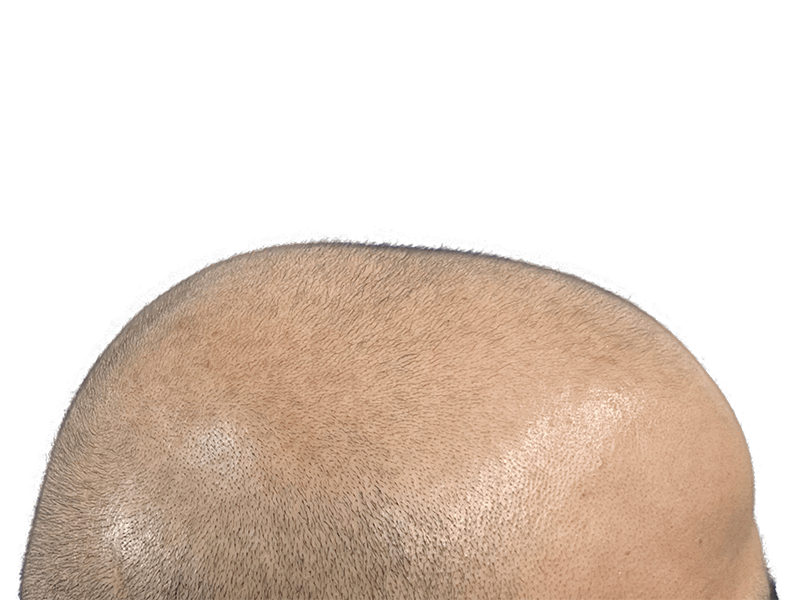 Hair restoration result: Dense, evenly distributed hair growth on scalp. Possible hair transplant procedure. Before/after potential.