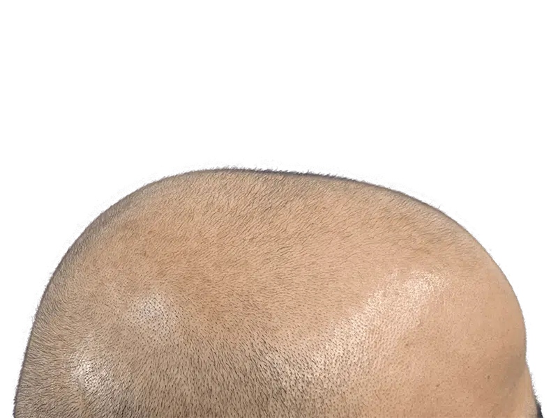 Hair restoration result: Dense, evenly distributed hair growth on scalp. Possible hair transplant procedure. Before/after potential.