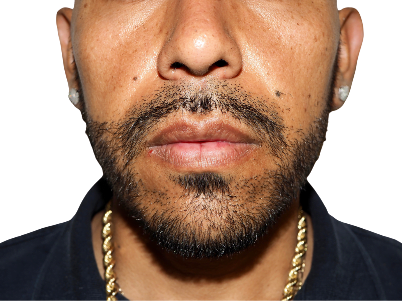 Hispanic man with beard. Natural hairline, no visible hair transplant. Hair restoration results may vary.