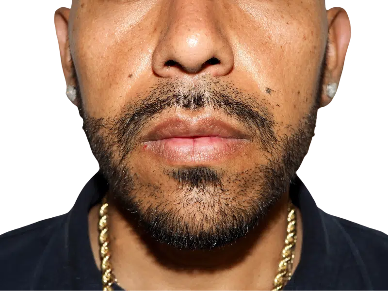 Hispanic man with beard. Natural hairline, no visible hair transplant. Hair restoration results may vary.