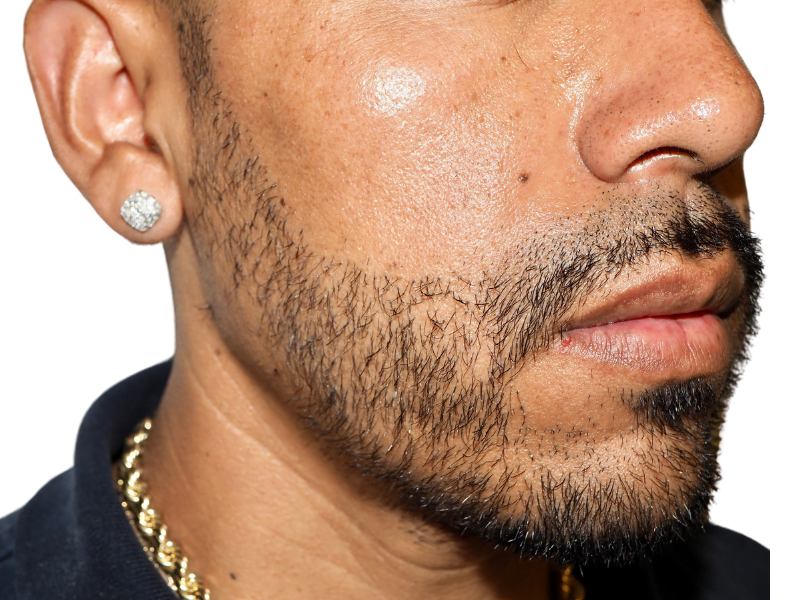 Patchy beard close-up. Potential hair transplant candidate. Beard restoration before/after? Hispanic male with light brown skin.