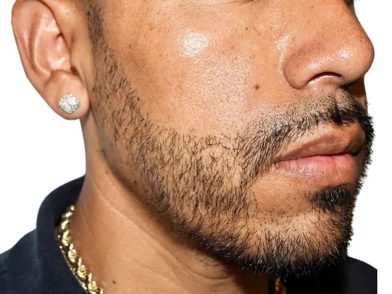 Patchy beard close-up. Potential hair transplant candidate. Beard restoration before/after? Hispanic male with light brown skin.