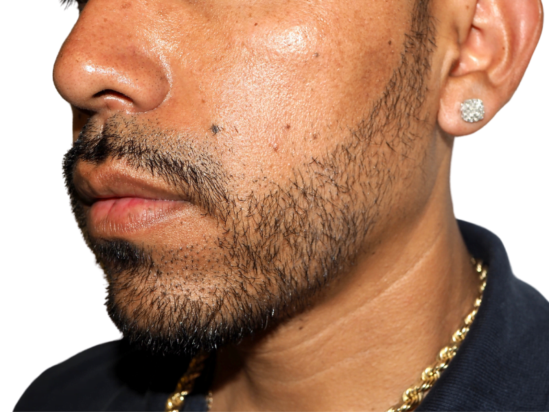 Patchy beard? See how hair restoration can transform your facial hair. Explore beard transplant options for a fuller look.