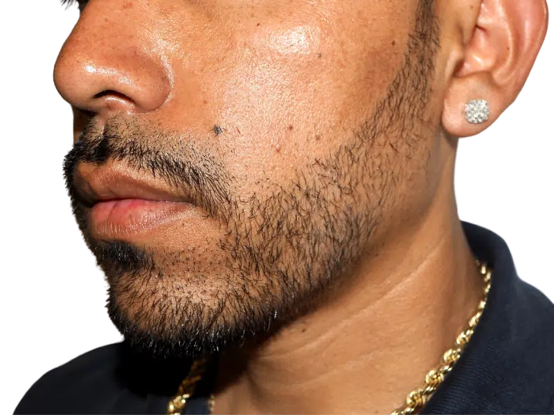 Patchy beard? See how hair restoration can transform your facial hair. Explore beard transplant options for a fuller look.