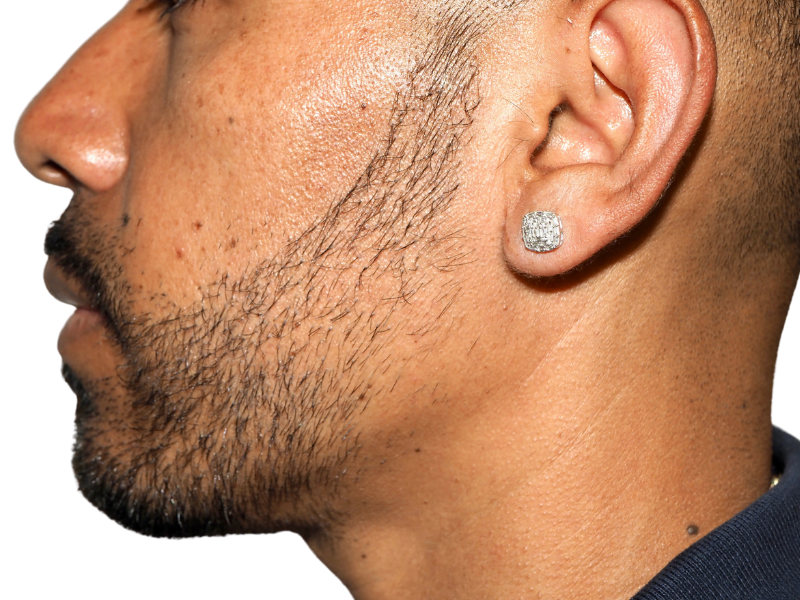 Man with sparse beard. Consider hair transplant for fuller facial hair. Before/After consultation available.