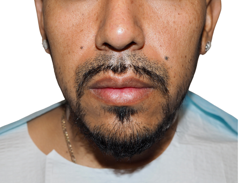 Hispanic man with goatee. Image doesn't show hair; not a hair transplant before/after. Focus on facial hair.