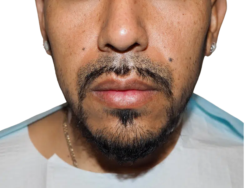Hispanic man with goatee. Image doesn't show hair; not a hair transplant before/after. Focus on facial hair.
