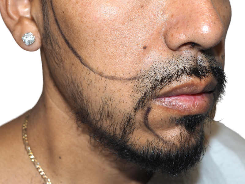 Before hair transplant: Hispanic man with beard marked for hair restoration. Shows planned procedure area.