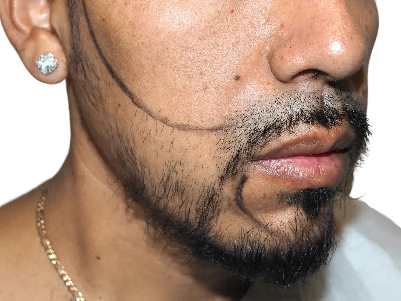 Before hair transplant: Hispanic man with beard marked for hair restoration. Shows planned procedure area.