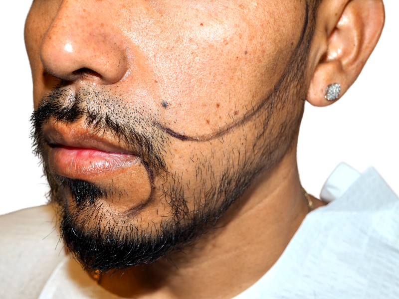 Beard transplant planning. Marked beard line for hair restoration procedure. Before potential hair transplant results. Earring visible.