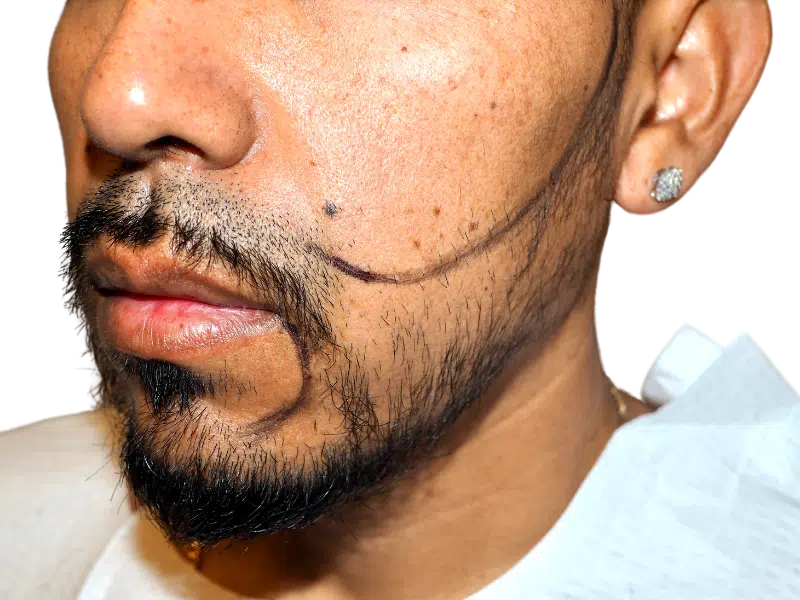 Beard transplant planning. Marked beard line for hair restoration procedure. Before potential hair transplant results. Earring visible.