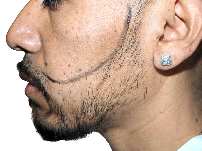 Beard hair transplant planning. Hispanic man's face marked for beard restoration. Consultation for hair transplant procedure.