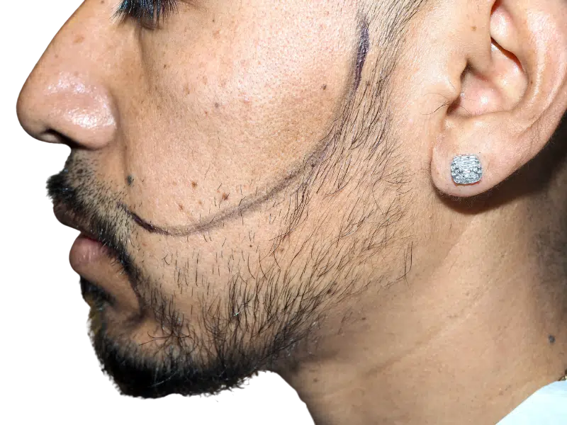Beard hair transplant planning. Hispanic man's face marked for beard restoration. Consultation for hair transplant procedure.