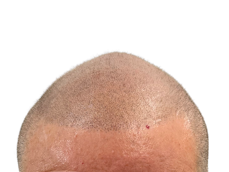 Hair transplant: Close-up of scalp showing new hair growth. Post-procedure dots visible. Hair restoration results.