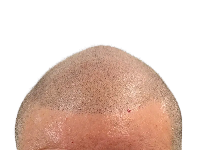 Hair transplant: Close-up of scalp showing new hair growth. Post-procedure dots visible. Hair restoration results.
