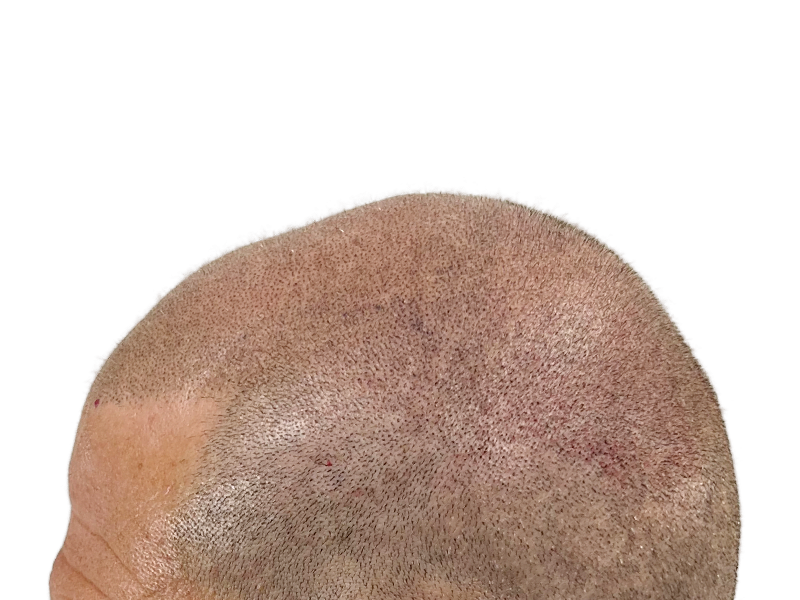 Hair transplant result: Close-shaved head showing even hair growth after restoration. Redness indicates recent procedure.