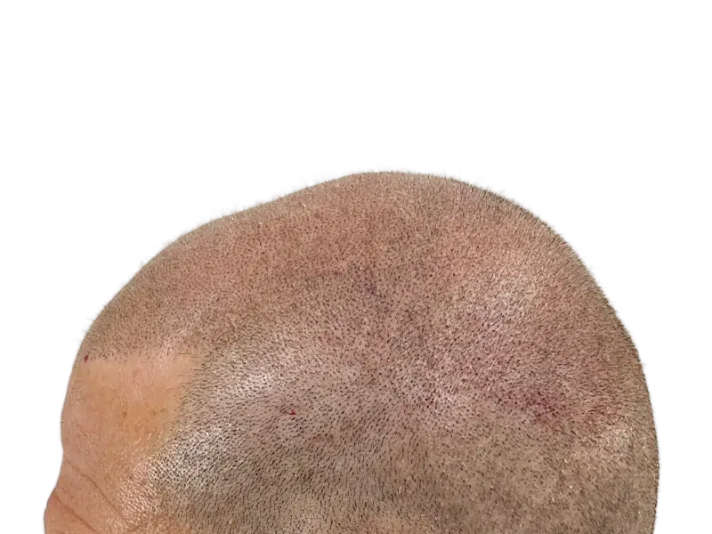 Hair transplant result: Close-shaved head showing even hair growth after restoration. Redness indicates recent procedure.
