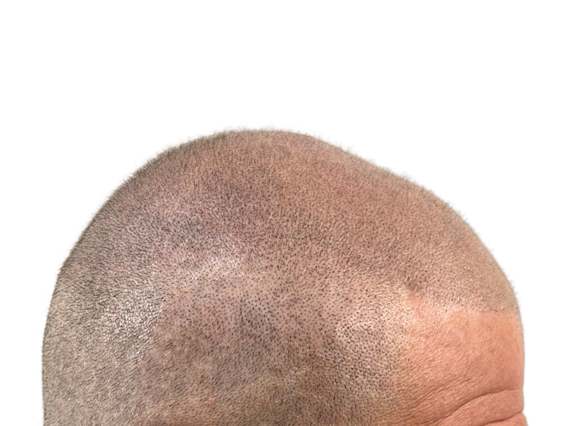 Hair transplant result: Close-up of scalp showing dense, even hair growth after restoration procedure. Successful hair restoration.
