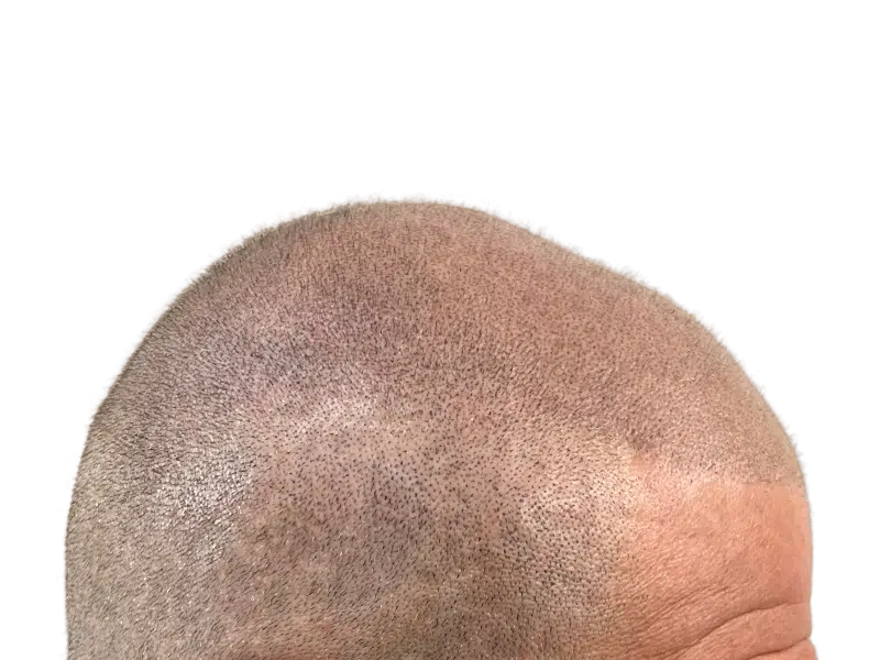 Hair transplant result: Close-up of scalp showing dense, even hair growth after restoration procedure. Successful hair restoration.