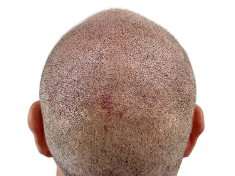 Hair thinning at crown. Possible hair transplant before. Scalp redness. Hair restoration services available.